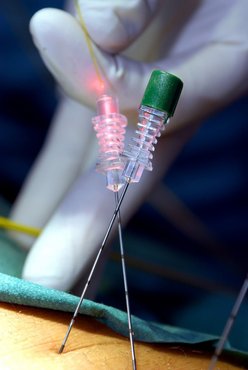 Interventionelle Schmerztherapie